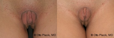 Case 10016 - Labia Majora Reduction 