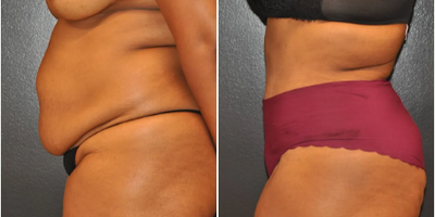 Case 1002 - Woman treated with Tummy Tuck