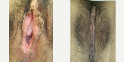 Case 10022 - Transformation: Hoodectomy, Vaginoplasty, and Labiaplasty on a 49-Year-Old Female
