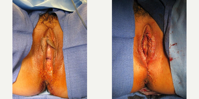 Case 10023 - 45-54 year old woman treated with Labia Majora Reduction, Labiaplasty, Perineoplasty, Vaginal Rejuvenation, Vaginoplasty