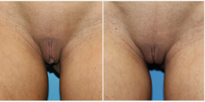 Case: 10029 - before and after photo of Woman treated with Labiaplasty by Christine A. Hamori, MD