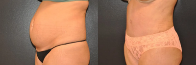 Case 1003 - Woman treated with Tummy Tuck