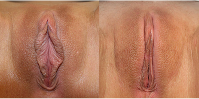 Case: 10030 - before and after photo of Woman treated with Labiaplasty by Christine A. Hamori, MD