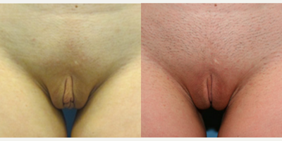 Case: 10031 - before and after photo of Woman treated with Labiaplasty by Christine A. Hamori, MD