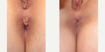 Case: 10034 - before and after photo of Woman treated with Labiaplasty by Wesley Anne Brady, MD