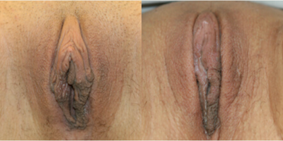 Case: 10037 - before and after photo of Woman treated with Labiaplasty by Christine A. Hamori, MD