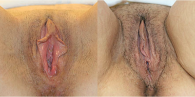 Case 10038 - Woman treated with Labiaplasty