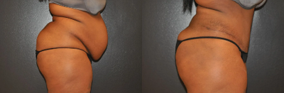 Case 1004 - Woman treated with Tummy Tuck