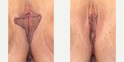 Case 10042 - Woman treated with Labiaplasty