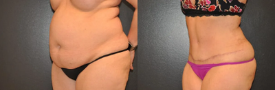 Case 1005 - Woman treated with Tummy Tuck