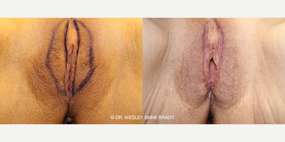 Case 10054 - Woman treated with Labiaplasty