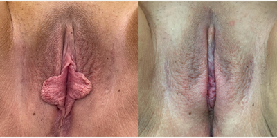 Case 10057 - 25-34 year old woman treated with Labiaplasty