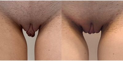 Case 10058 - 18-24 year old woman treated with Labiaplasty