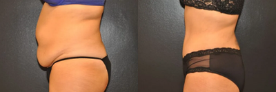 Case 1006 - Woman treated with Tummy Tuck