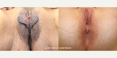 Case 10061 - Woman treated with Labiaplasty