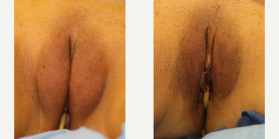 Case 10064 - 35-44 year old woman treated with Labiaplasty