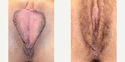 Case 10068 - 25-34 year old woman treated with Clitoral Hood Reduction, Labiaplasty