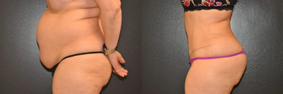 Case 1007 - Woman treated with Tummy Tuck