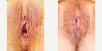 Case 10073 - Woman treated with Labiaplasty