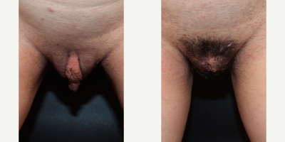 Case 10075 - Woman treated with Labiaplasty