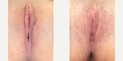 Case 10077 - Woman treated with Labiaplasty