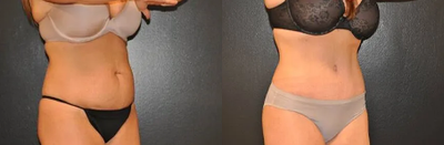 Case 1008 - Woman treated with Tummy Tuck