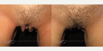 Case 10080 - Woman treated with Labiaplasty