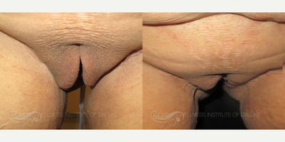 Case 10081 - Woman treated with Labiaplasty