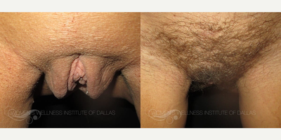 Case 10082 - Woman treated with Labiaplasty