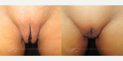 Case 10083 - Woman treated with Labiaplasty