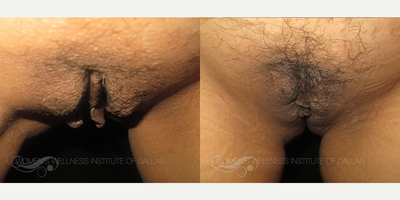 Case 10084 - Woman treated with Labiaplasty