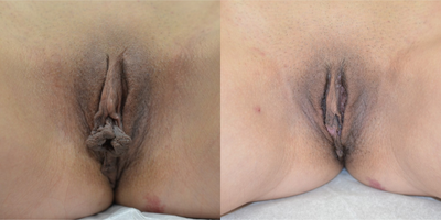 Case 10085 - 35-44 year old woman treated with Labiaplasty