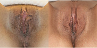 Case 10087 - Woman treated with Labiaplasty
