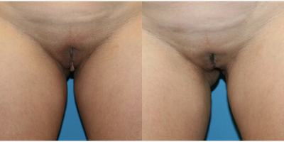 Case 10088 - Woman treated with Labiaplasty