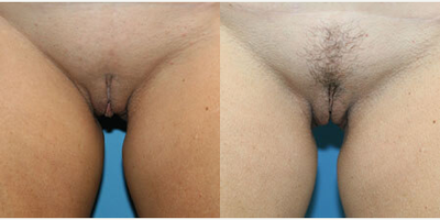 Case 10089 - Woman treated with Labiaplasty