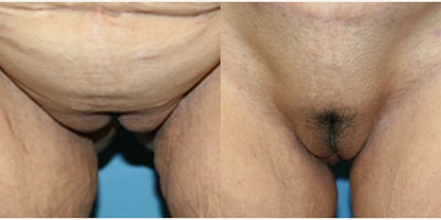 Case 10090 - Woman treated with Labiaplasty