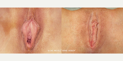 Case 10091 - 36 year old woman treated with Vaginoplasty, Clitoral Hood Reduction, Labiaplasty