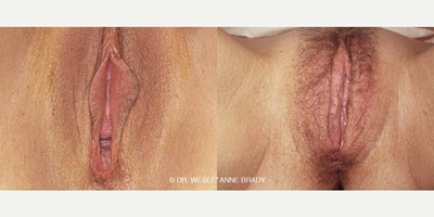 Case 10092 - 40 year old woman treated with Vaginoplasty, Labiaplasty