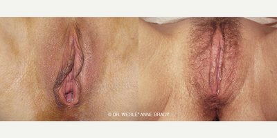 Case 10093 - 47 year old woman treated with Vaginoplasty, Labiaplasty, Clitoral Hood Reduction