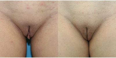 Case 10095 - Woman treated with Labiaplasty