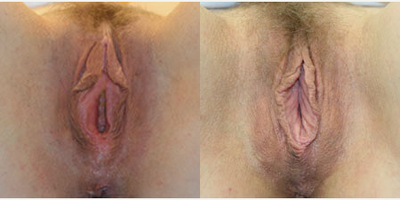 Case 10097 - Woman treated with Labiaplasty