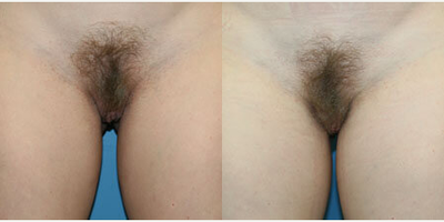 Case 10098 - Woman treated with Labiaplasty