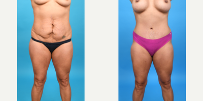 Case 101 - 25-34 year old woman treated with Abdominal Etching, Diastasis Recti Repair, Drainless Tummy Tuck, Liposuction, Mini Tummy Tuck,