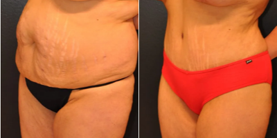 Case 1010 - Woman treated with Tummy Tuck