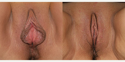 Case 10100 - Woman treated with Labiaplasty