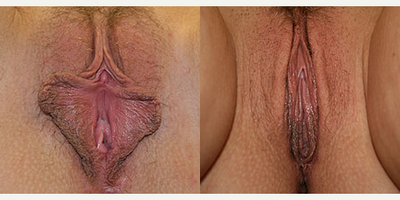 Case 10101 - Woman treated with Labiaplasty