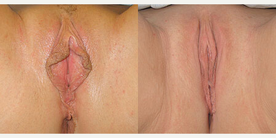 Case 10102 - Woman treated with Labiaplasty