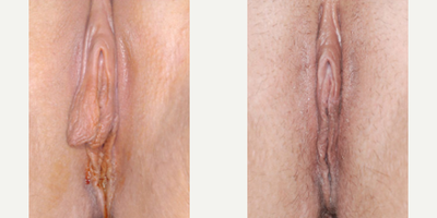 Case 10106 - Woman treated with Labiaplasty