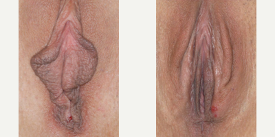 Case 10107 - Woman treated with Labiaplasty