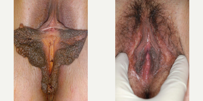 Case 10108 - Woman treated with Labiaplasty
